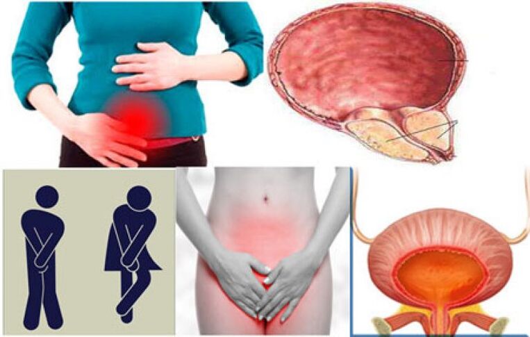 Signs of cystitis in women - burning and pain during urination